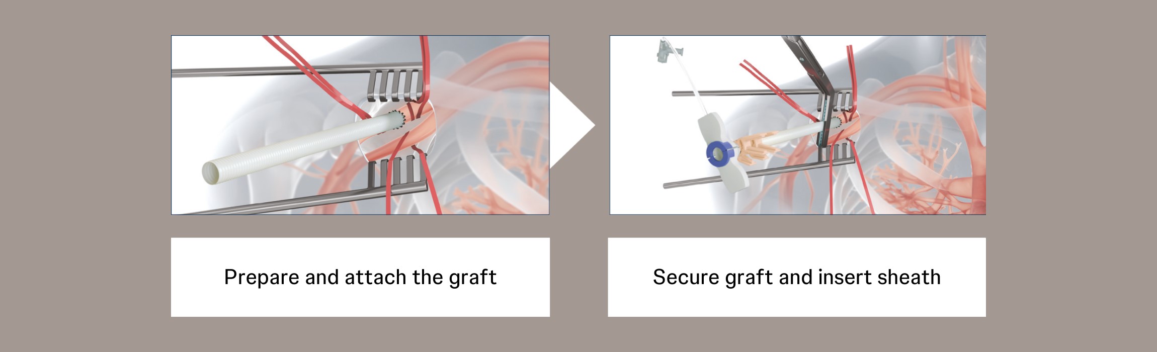 Step-by-Step-Axillary_AttachGraftInsertSheath