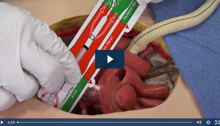 Impella® Skills Video: Impella 5.5® with SmartAssist® Direct Aortic Insertion